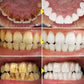 5-Day Teeth Whitening Powder - Plaque and Stain Cleaning Care